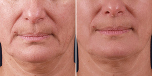 exilis
