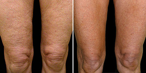 exilis