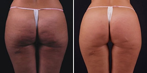 exilis