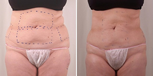 exilis
