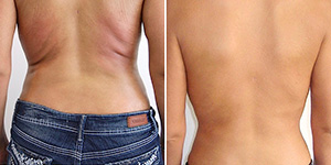 exilis