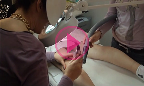 exilis neinvazivna liposukcija video